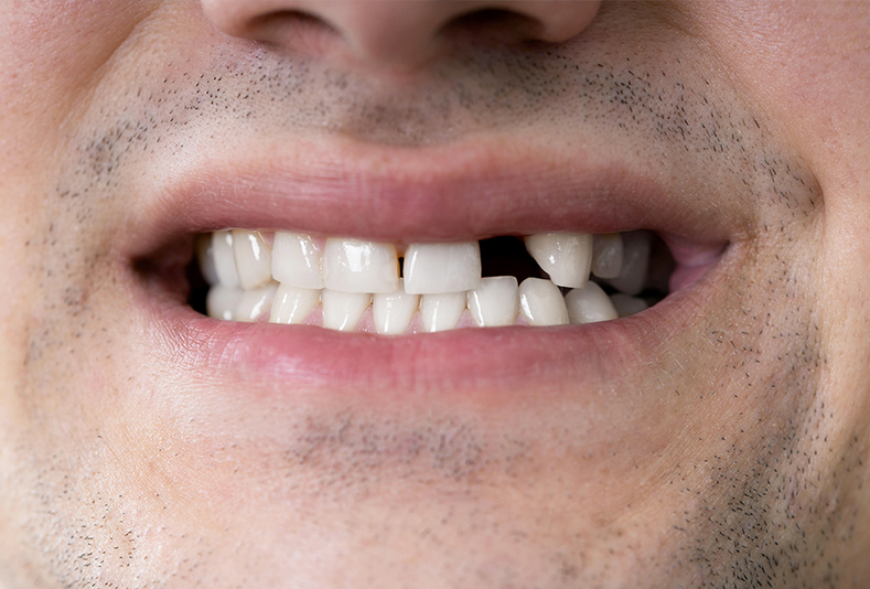 Primo piano di sorriso di un uomo con denti mancanti