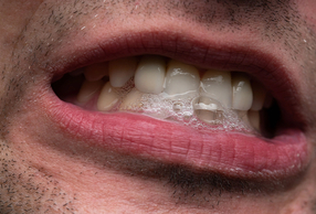Associazione tra caratteristiche salivari e usura dentale: una revisione sistematica