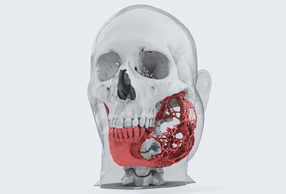 rappresentazione ameloblastoma