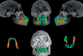 Evoluzione e ontogenesi dentale nei primi Homo