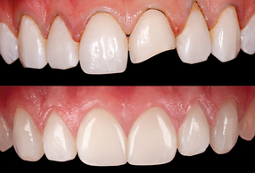 Prima e dopo l'utilizzo delle faccette Prettau Skin di Zirkonzahn