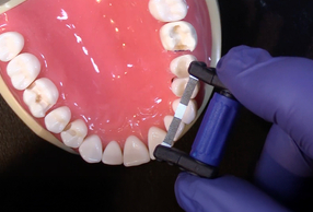 kit strisce subgengivali per finitura e modellazione FitStrip