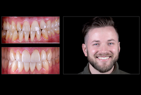 Riabilitazione mininvasiva con faccette in zirconia ultrasottili (0,2 mm) e restauri posteriori parziali