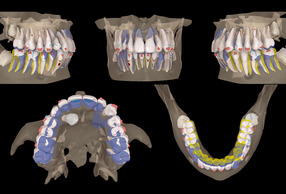 Protocollo Canine First nel recupero dei canini mascellari inclusi in S5