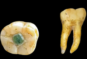 Dente con otturazione in giadeite