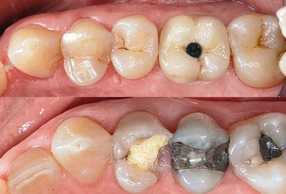Primo piano di impianti dentali 