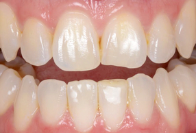 Miglioramento estetico trattamento post-ortodontico con 3M™ Filtek™ Easy Match Universal Restorative Risultato finale dopo miglioramento estetico