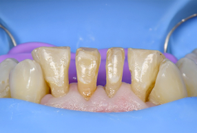 Tecnica Injection Molding per faccette dirette con Solventum™ Filtek™ Easy Match Flowable Restorative Tecnica Injection Molding per faccette dirette