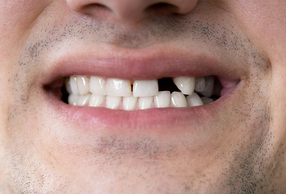 Primo piano di sorriso di un uomo con denti mancanti
