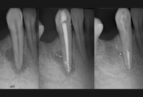 trattamento endodontico