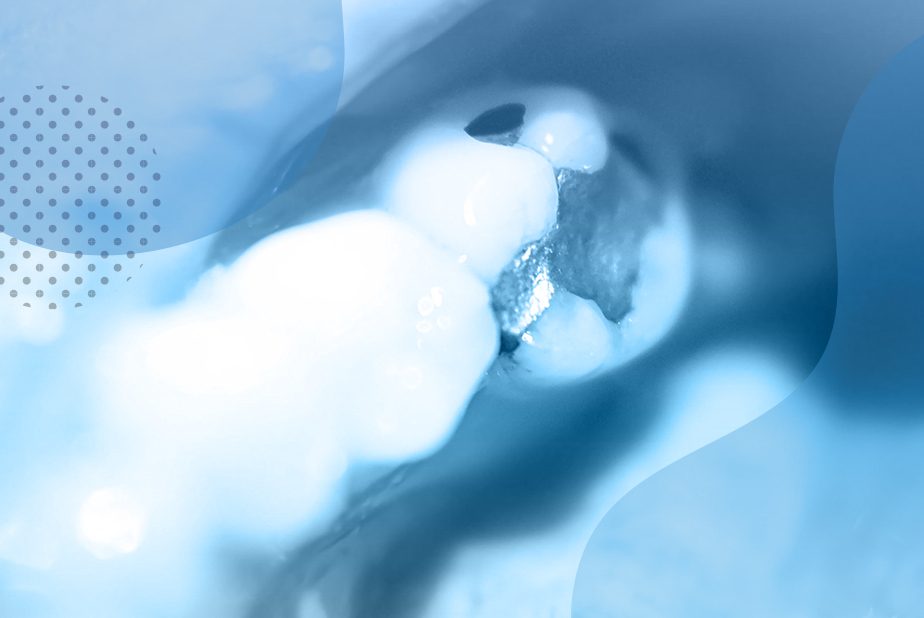 Immagine di amalgama dentale
