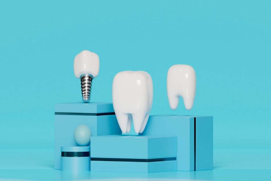 rappresentazione tridimensionale denti e impianto dentale