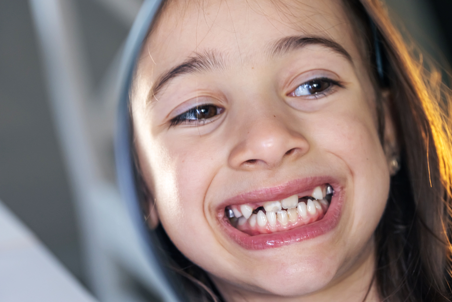 bambina mostra denti anteriori demineralizzati