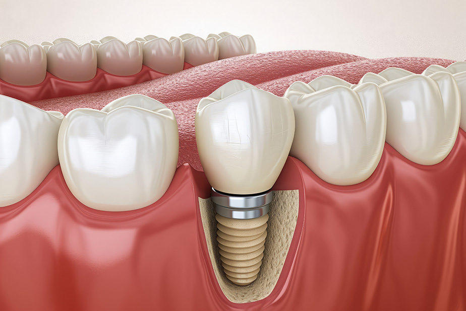 impianto dentale installato