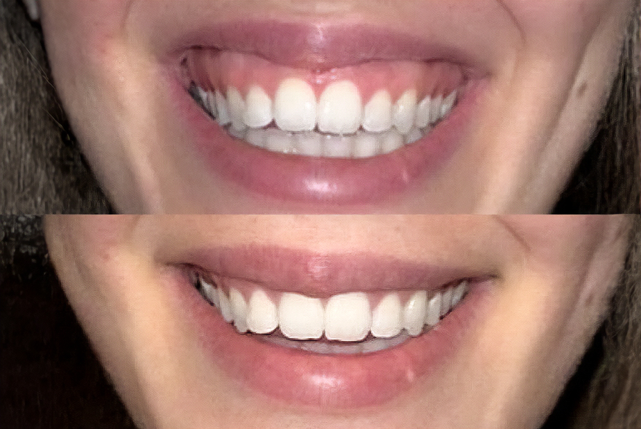 applicazione della tossina botulinica per il trattamento del gummy smile