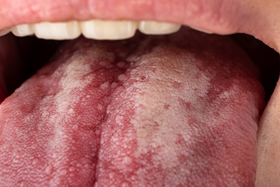 Sindrome della bocca urente