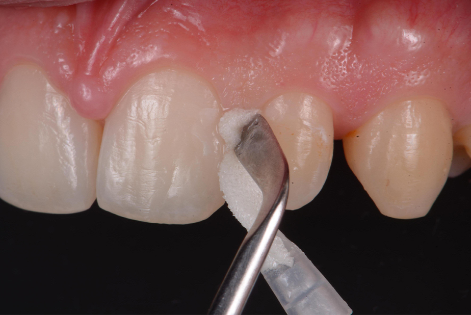 applicazione CURODONT™ REPAIR