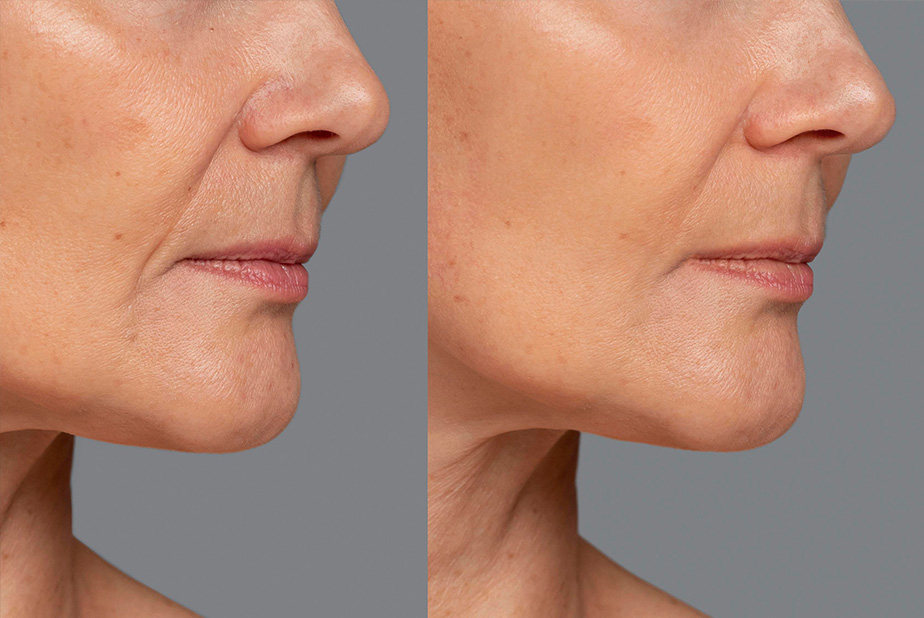 Biorivitalizzazione periorale con peptidi biomimetici Prima e dopo biorivitalizzazione