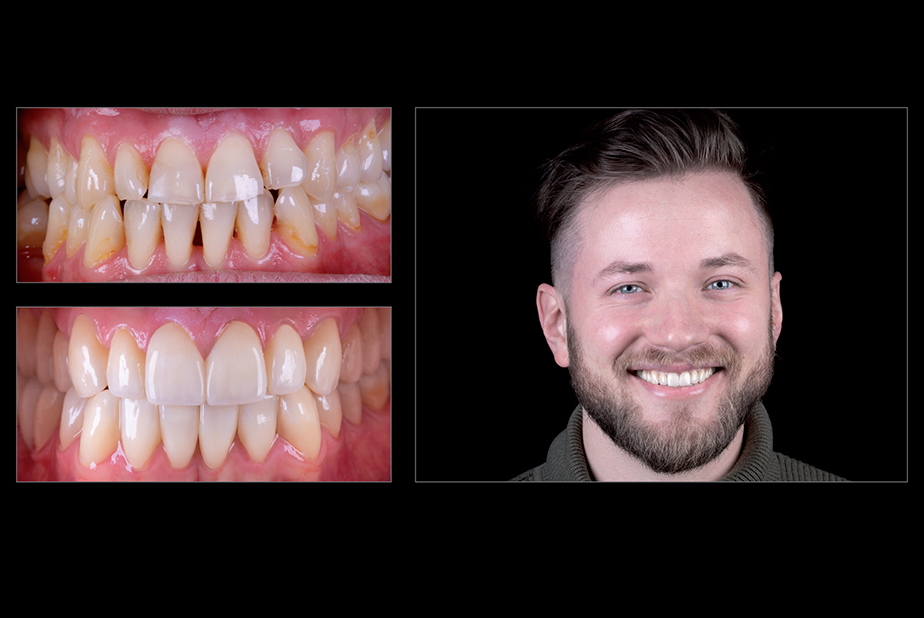 Riabilitazione mininvasiva con faccette in zirconia ultrasottili (0,2 mm) e restauri posteriori parziali