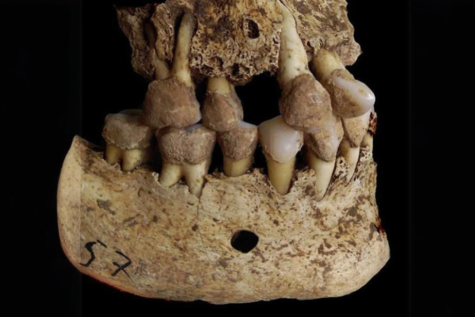 Anche gli antichi soffrivano di parodontite: lo studio di Pisa lo conferma Dentatura etrusca