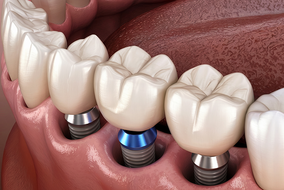impianti dentali