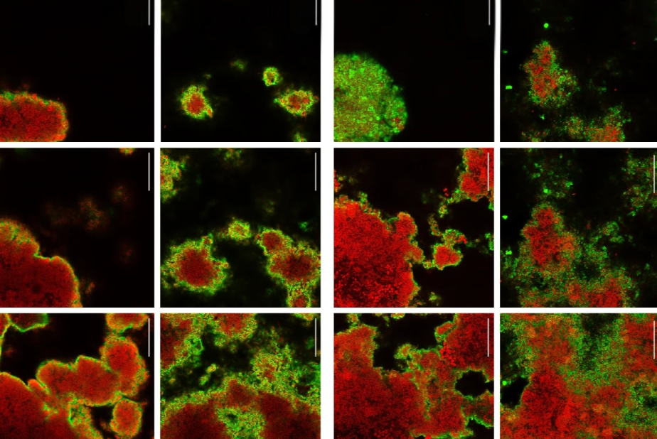 Arginina e carie: come cambia il biofilm dentale nei pazienti ad alto rischio