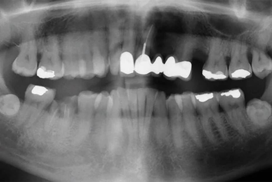 Continuità delle cure orali nei pazienti HNC Radiografia di paziente HNC