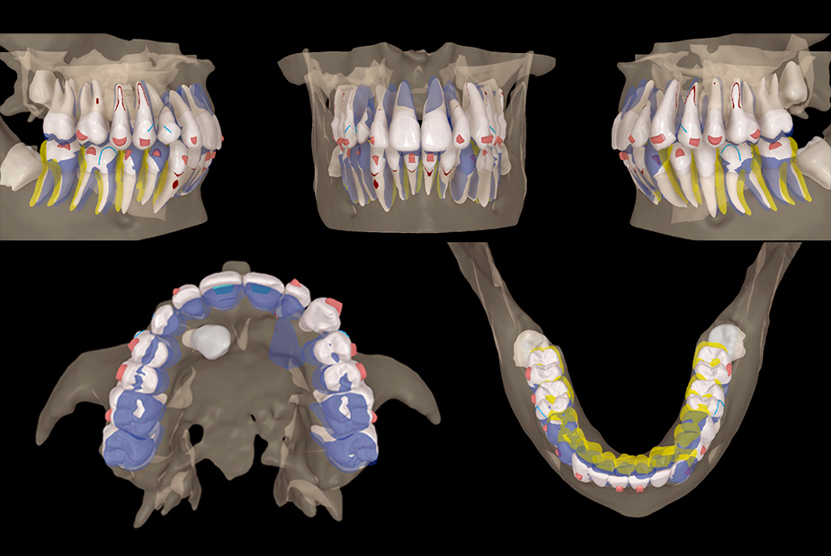 Protocollo Canine First nel recupero dei canini mascellari inclusi in S5