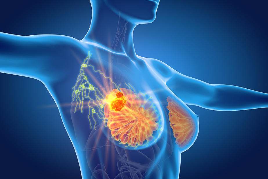 Parodontite e cancro al seno: nuovo studio sui batteri orali illustrazione di corpo femminile con massa nel seno
