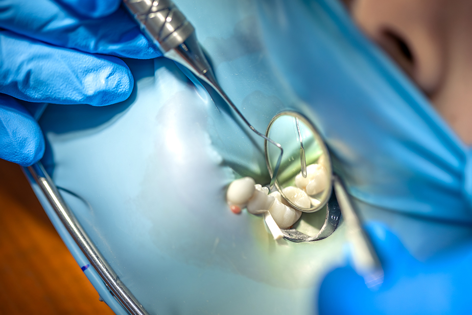 Pulpotomia terapeutica nei denti permanenti con pulpite irreversibile Pulpotomia