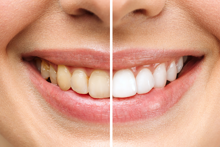 Primo piano del sorriso di una ragazza diviso a metà, una metà ha un colore di denti più gialli, l'altra metà li ha più bianchi