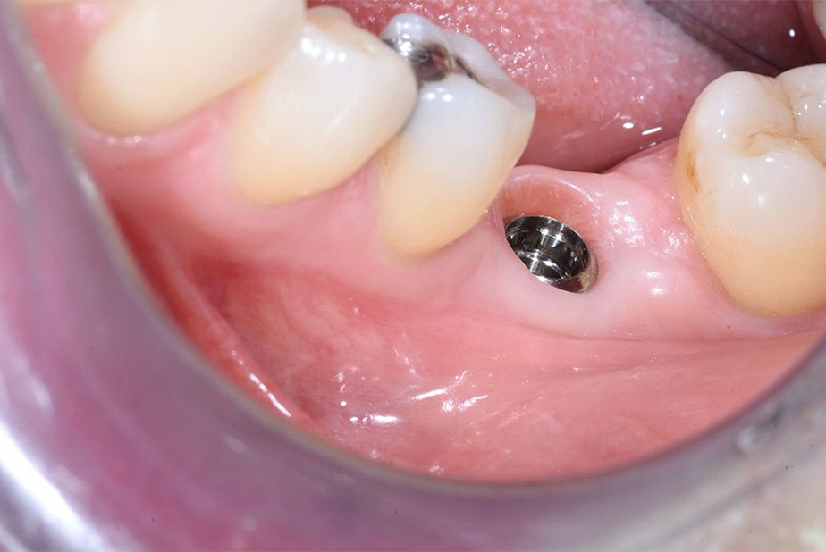 Impianti intelligenti contro la perimplantite Primo piano di denti di una bocca