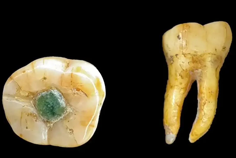 Dente con otturazione in giadeite