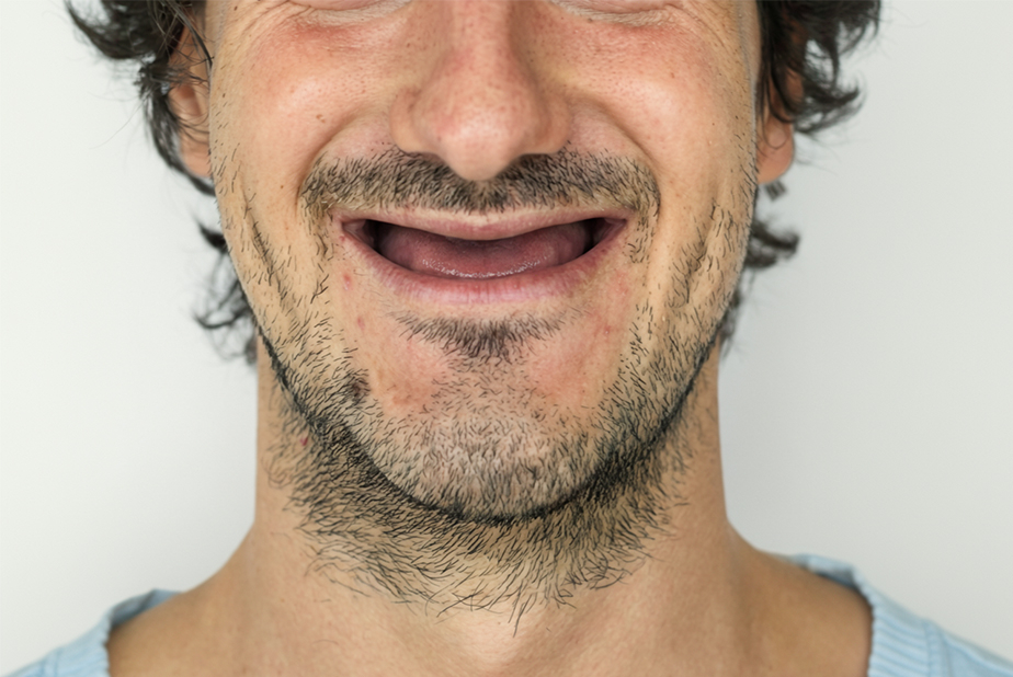 primo piano di bocca di un uomo con edentulia