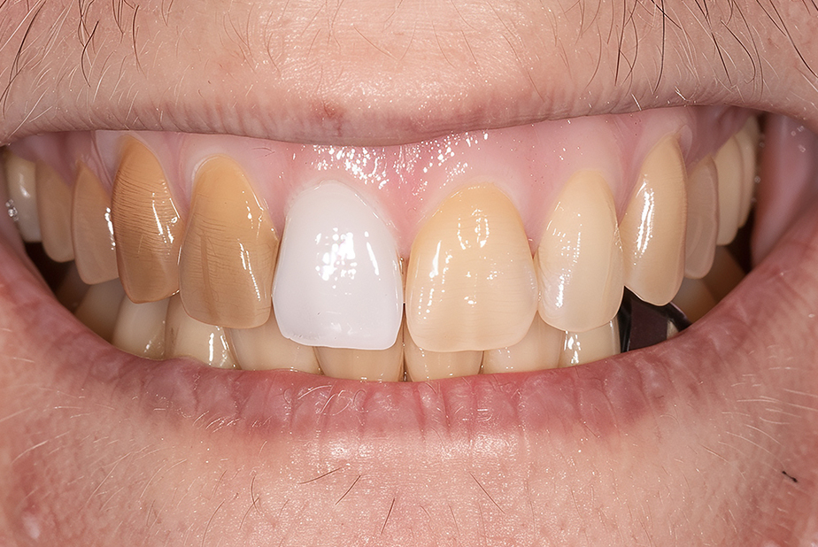 alterazione del colore dei denti