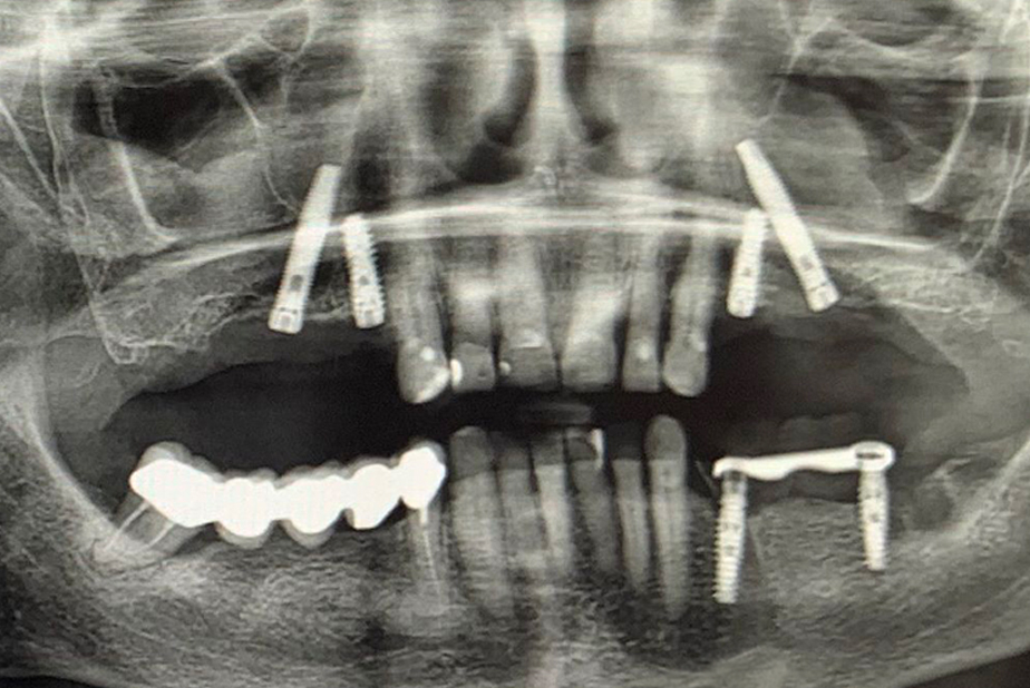 Riabilitazione del mascellare superiore con approccio implantare combinato: impianti convenzionali e transinusali 