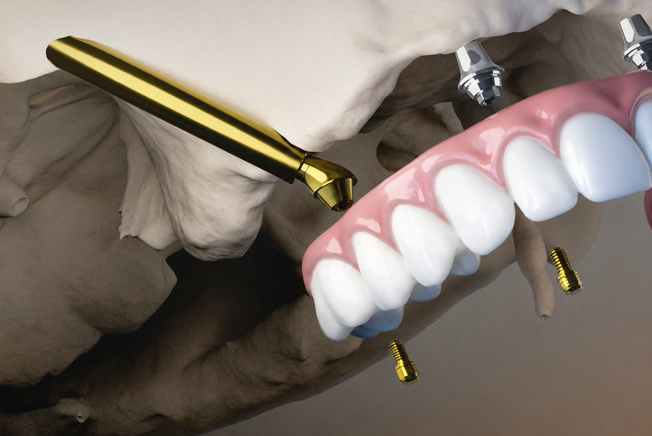 ProZygoma di BioHorizons