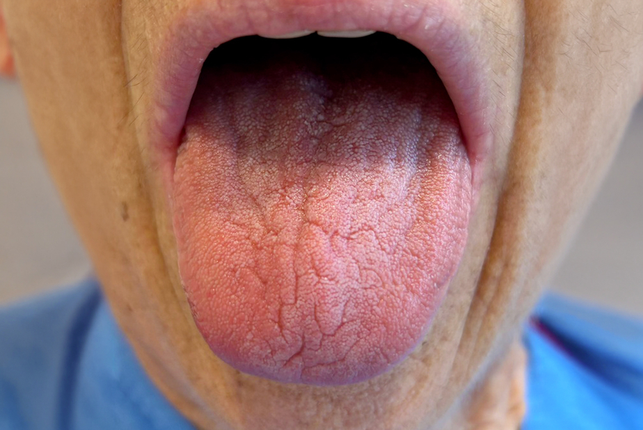 paziente con xerostomia
