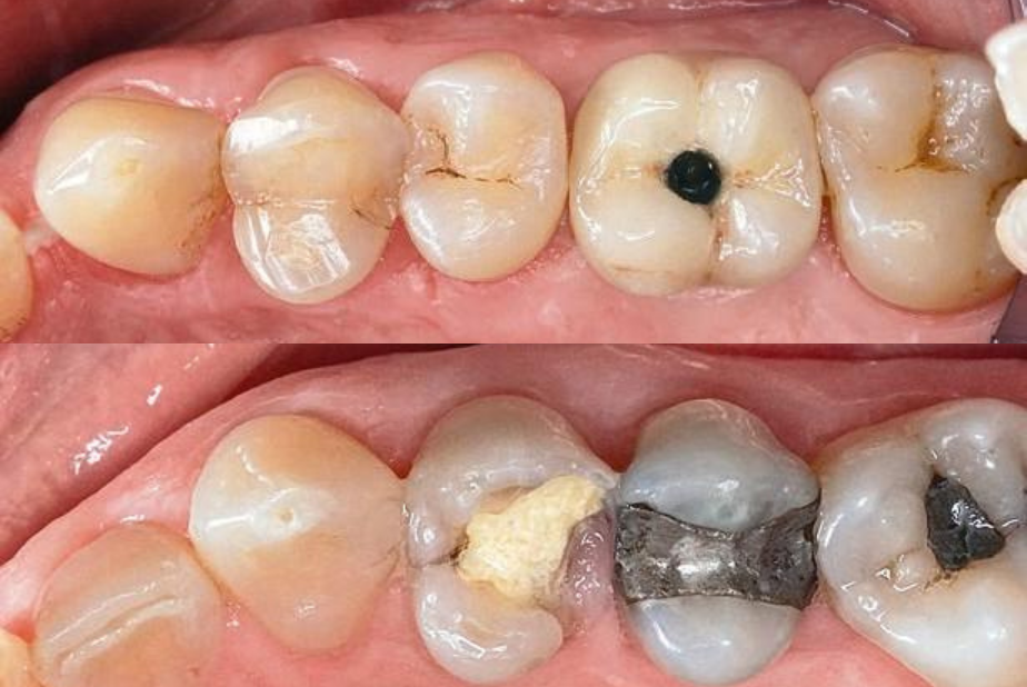 Primo piano di impianti dentali 