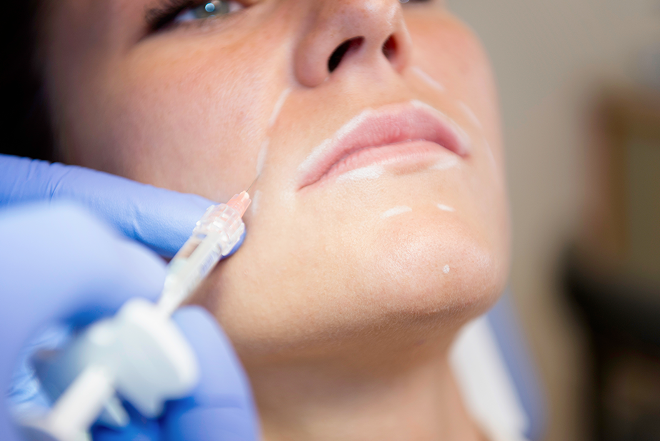 Quando i filler lasciano segni permanenti donna che si sottopone a iniezione di filler sul viso