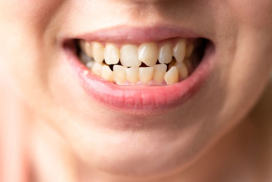 Affollamento dentale negli adolescenti affollamento dentale