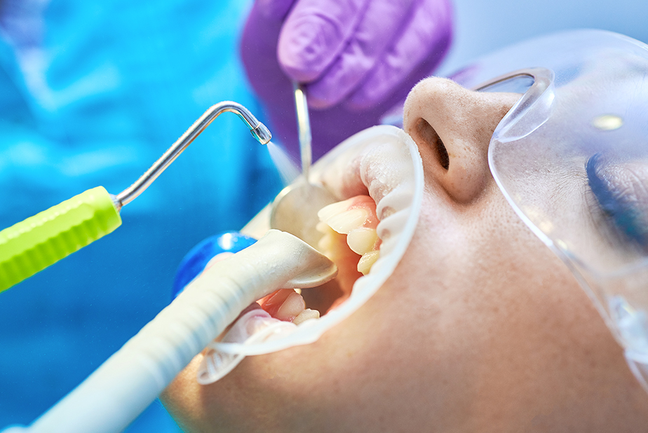 Air polishing in odontoiatria: benefici clinici, comfort e gestione del biofilm Air Polishing