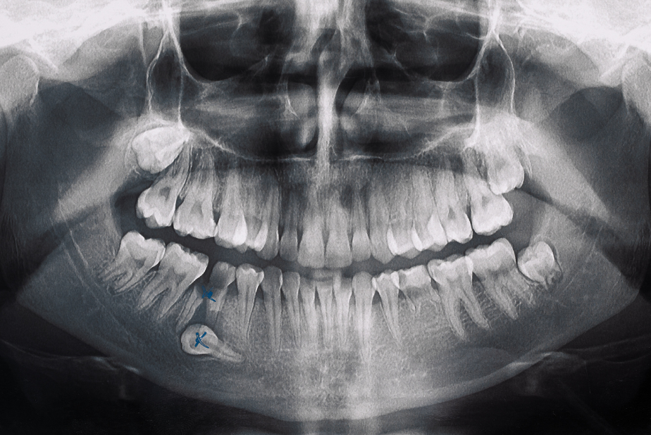 Gestione clinica e chirurgica degli elementi dentari inclusi Radiografia