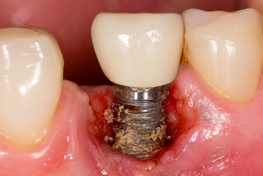 Perimplantite