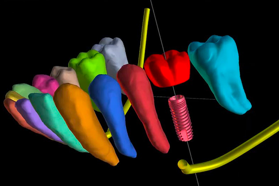 L'intelligenza artificiale nella pianificazione implantare Software di pianificazione implantare