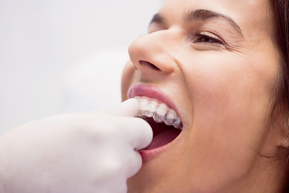 primo piano di donna che effettua sbiancamento dentale con allineatori trasparenti