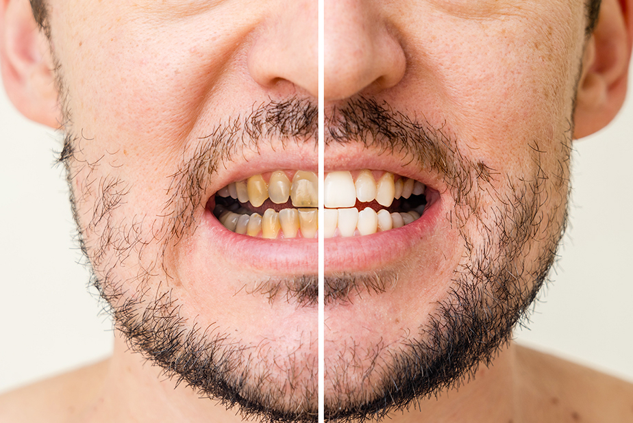 Primo piano di sorriso di uomo diviso in prima e dopo