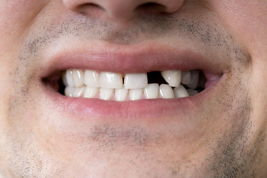 Denti che rispuntano dopo i quaranta? La ricerca ci si sta avvicinando Primo piano di sorriso di un uomo con denti mancanti