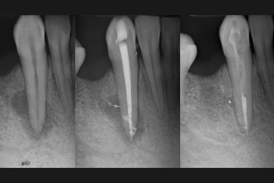trattamento endodontico