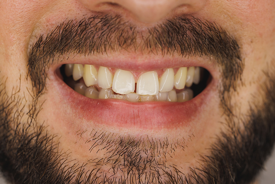 Erosione dello smalto dentale: la cheratina mostra un potenziale remineralizzante primo piano di sorriso di uomo